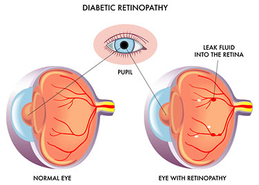 Diabetic Retinopathy Patel Eye Associates New Jersey