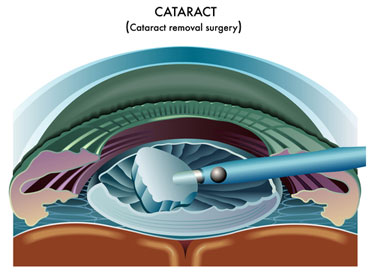 cataract surgery Patel Eye Associates New Jersey