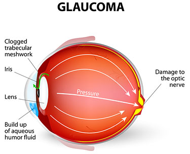 glaucoma Patel Eye Associates New Jersey